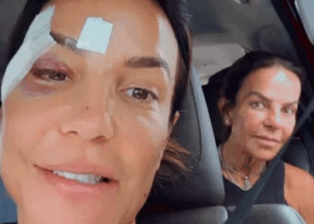 Com olho roxo após desmaiar, Ivete Sangalo comemora alta hospitalar