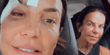 Com olho roxo após desmaiar, Ivete Sangalo comemora alta hospitalar